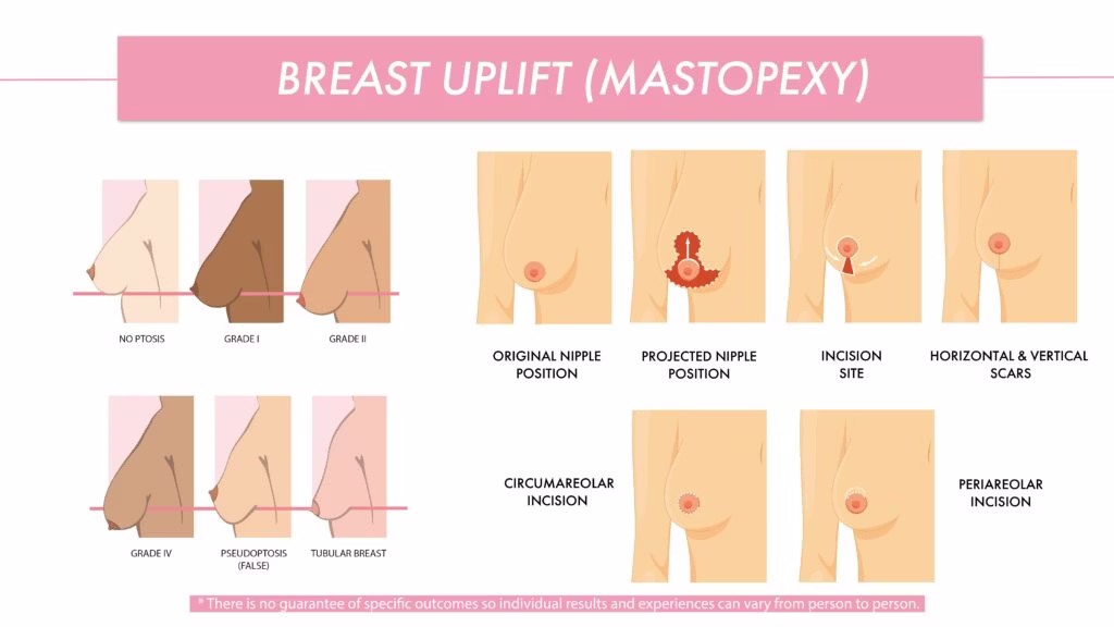 Mastopexy